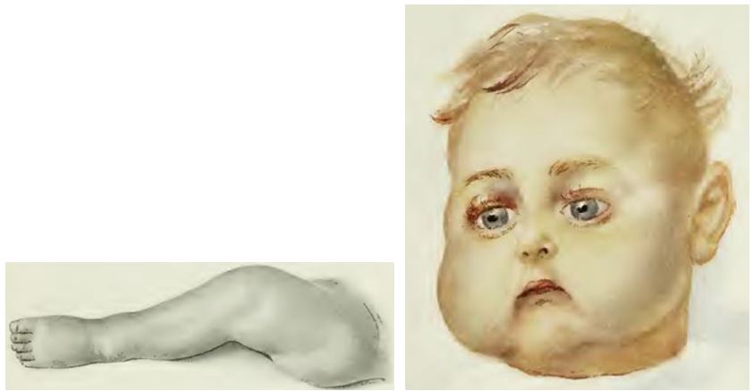 14_Bendix_1913_p129 und nachp128_Vitaminmangelkrankheit_Moeller-Barlowsche-Krankheit