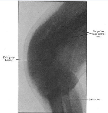17_Salge_1910_p335_Vitaminmangelkrankheit_Moeller-Barlowsche-Krankheit_Roentgenbild