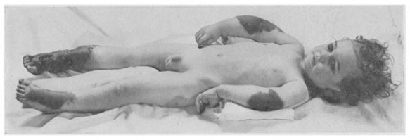 18_Feer_1922_p075_Vitaminmangelkrankheit_Moeller-Barlowsche-Krankheit